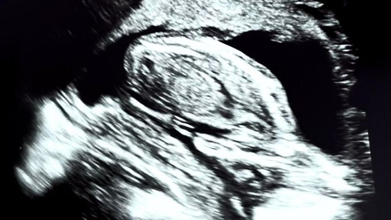 Ultraschallbild von Taddls Baby