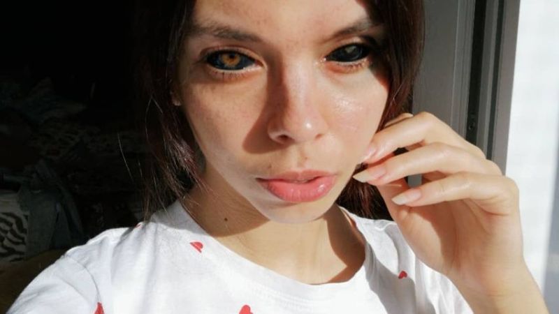 Dank Augen-Tattoos: 25-jährige Influencerin ist jetzt blind!